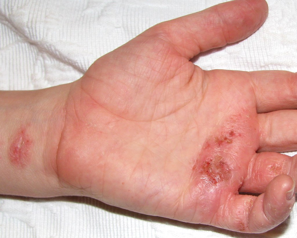 Bild - Ekzem an der Hand